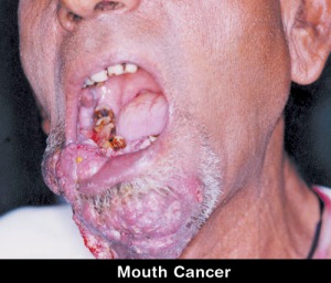 kanker-mulut1