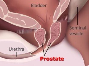 kanker prostat